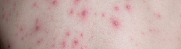 Las zoonosis